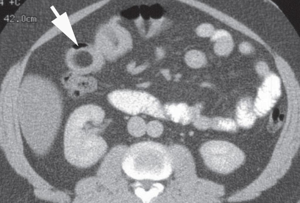 Fig. 3: Oral and intravenous contrast-enhanced CT scan shows an intraluminal mass of fat attenuation within the small