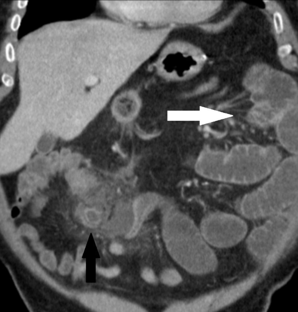 Fig. 4: Coronal CT scan shows bowel obstruction (white arrow) to perforated Meckel's diverticulum (black