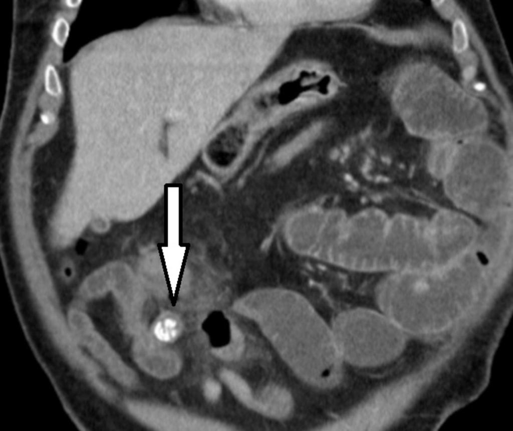 Fig. 5: Sagittal CT scans show enterolith (black arrow) in dilated infected Meckel's diverticulum.