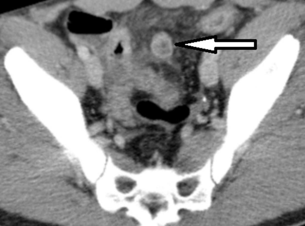 Fig. 7: Intravenous contrast-enhanced CT scan shows a blind-ending rounded structure (arrow) attached to the