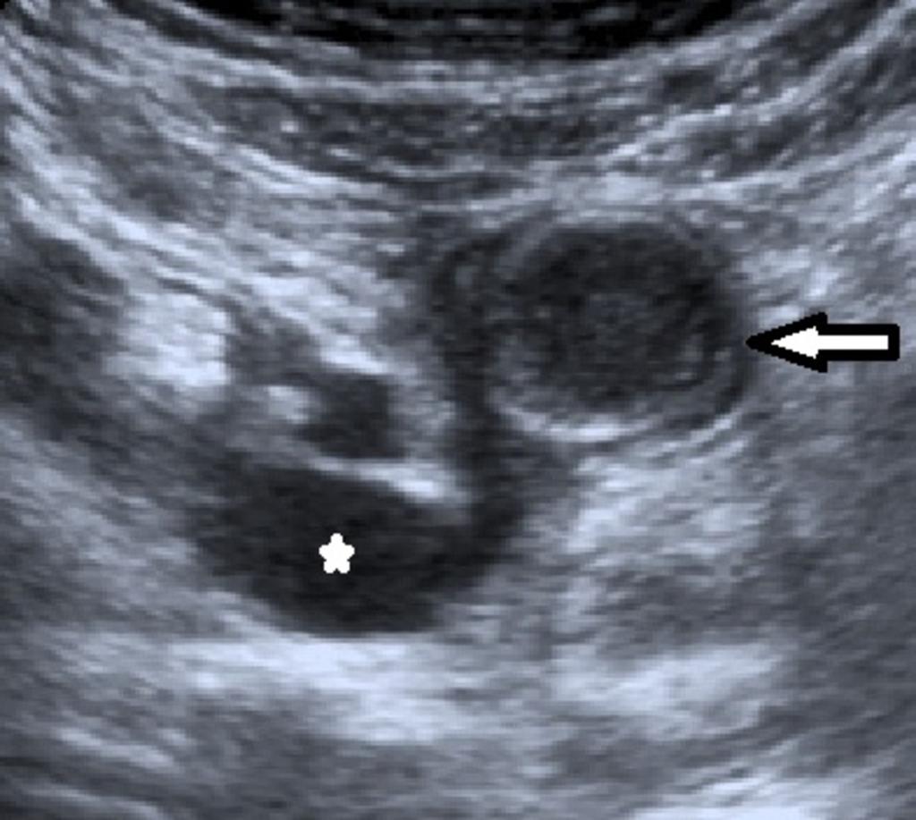 Fig. 9: Transversal sonogram of the pelvis shows a blind-ending, tubular cystlike structure containing internal echoes from