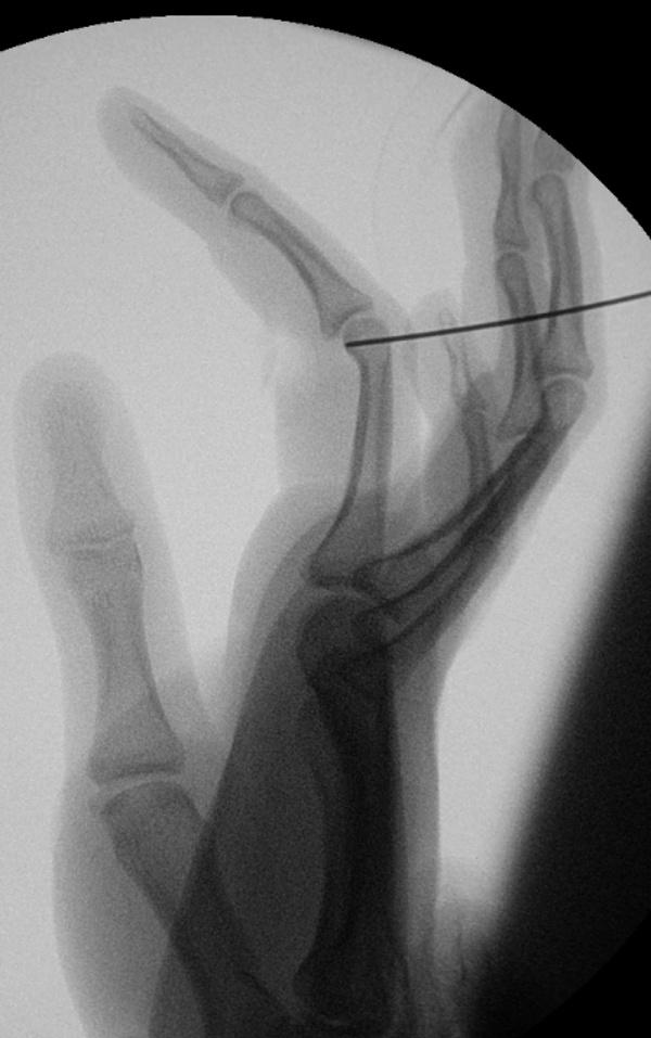 43 Figure 3: Intra operative radiograph showing reduction of fracture with the K wire passed from dorsal aspect.