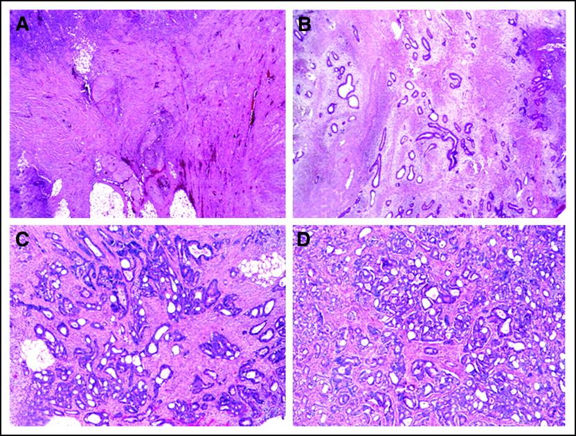 Tumor regression grading (TRG) after preoperative chemoradiotherapy : (A) total regression, no viable tumor cells, only fibrotic mass, TRG 4; (B) dominant fibrosis outgrowing the tumor mass (>50%