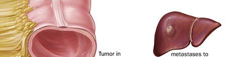 Colon cancer staging 5 year Survival by Stage Stage