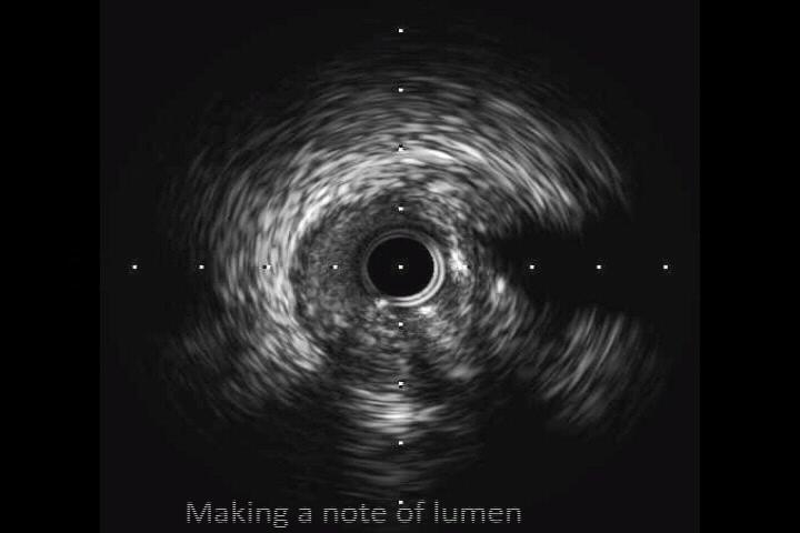 Assessment observation the IVUS 3 : Training method 1. Running a IVUS video 2. Making a note of only lumen 3.