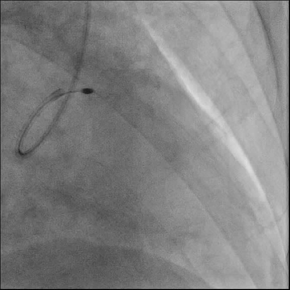 Proximal reference marking Distal reference marking Using The We measured left IVUS, panel