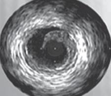 Intravascular Ultrasound (IVUS) S Mokaddas