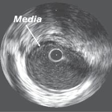 New IVUS Criteria for Functionally significant