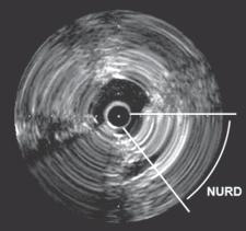 Intravascular Ultrasound (IVUS) S Mokaddas Hossain (Sadi) Fig.-10: VH-IVUS Imaging Fig.-9: Catheter Bending Saphenous Vein Grafts In situ veins do not have an EEM.