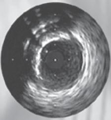 In practice calcium is echo dense (hyperechoic) plaque (brighter than the reference adventitia) that shadows using IVUS calcium can be localized and characterized as superficial (closer to
