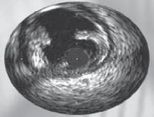 The intimal hyperplasia of late in-stent restenosis may appear more echogenic.