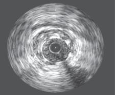 16,17 clues to the presence of thrombus include the following 1) Sparkling Scintillating appearance 2) Lobulated mass projecting into the lumen Fig.