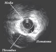 Intravascular Ultrasound (IVUS) 3) A distinct interface between the suspected thrombus and under lying plaque.