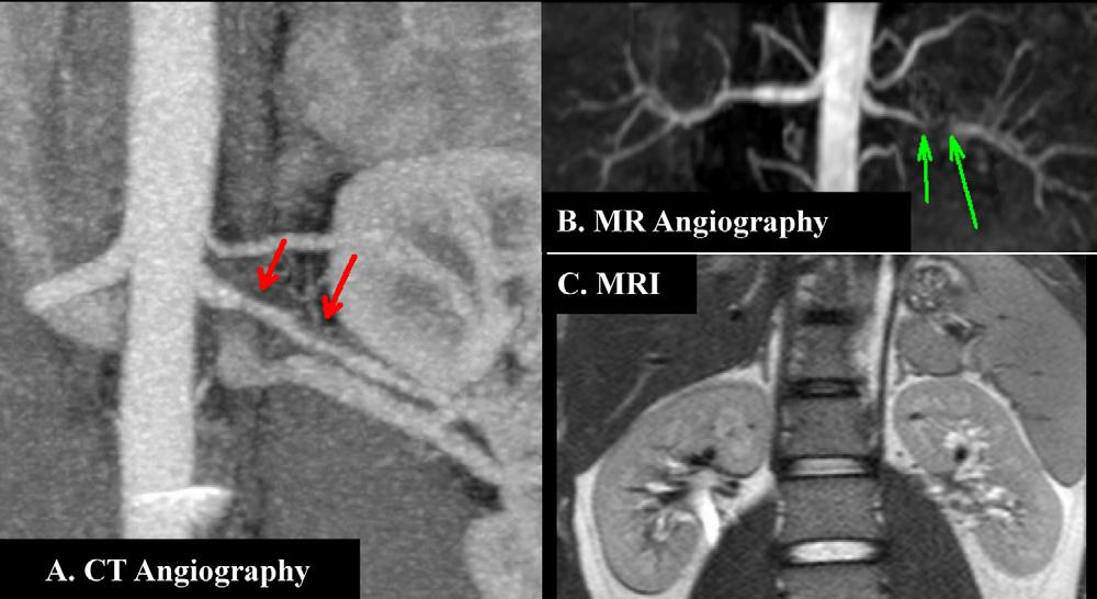 Captopril-99mTc-DTPA renoscintigraphy showed that GFR of the left kidney was lowered than that of the control [captopril-induced reduction rate (CRR, 17.