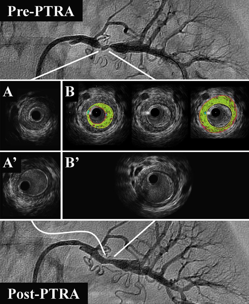 IVUS- and pressure gradient-guided renal angioplasty e165 Figure 3 The pre- and post-percutaneous transluminal renal angioplasty (PTRA) selective left renal arteriogram (top and bottom) and serial
