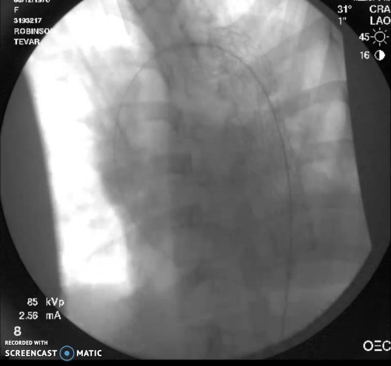 CASE 1 Pre-deployment Wire parked in left subclavian through left brachial access IVUS Diameter of proximal landing zone measured Distance from aneurysm