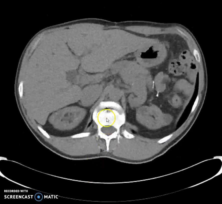 CASE 2 42yo male Liver failure due to Caroli syndrome Renal failure due to polycystic kidney disease Pending liver