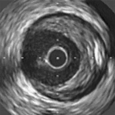 IVUS Reveals Angiographically Invisible Lesions Images