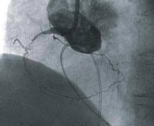Stenting a CTO
