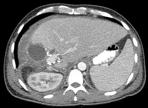 INTERVENTION: BILIARY DRAINAGE Follow up CT abdomen (coronal