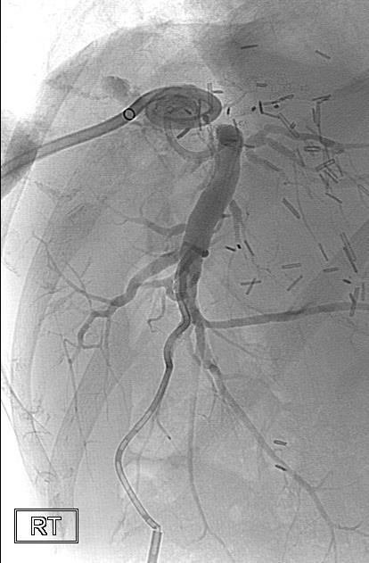 Cholangiogram demonstrated no direct connections between the biloma /right percutaneous pigtail (black arrow) and the CBD and/or the left biliary system.