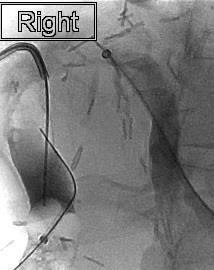Subsequently a wire from the left duct access was also advanced into the CBD Resected right lobe Biloma Rendezvous procedure with