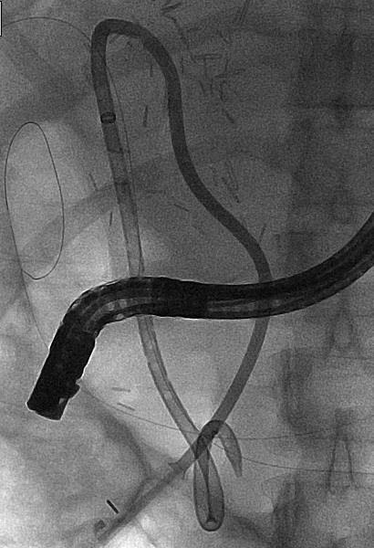 INTERVENTION: RENDEZVOUS The pigtail was snared and retracted out the left access to establish a platform to place a conventional left internal external biliary tube The pigtail was then advanced to