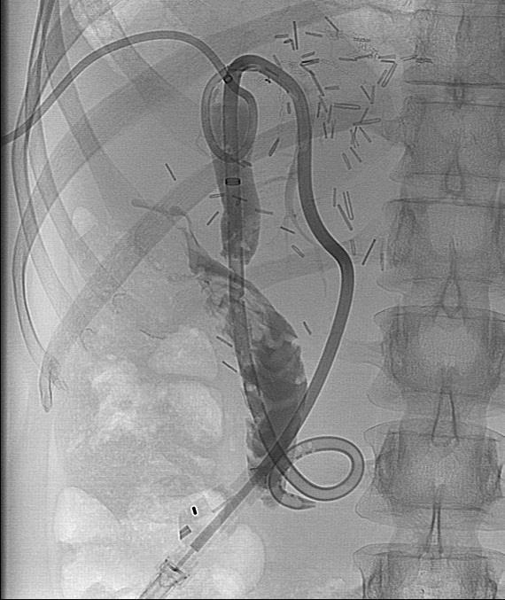 INTERVENTION: RENDEZVOUS 10 days post procedure, cholangiogram demonstrates complete decompression of the prior biloma and patent biliary drainage to the duodenum The right biloma drain was removed