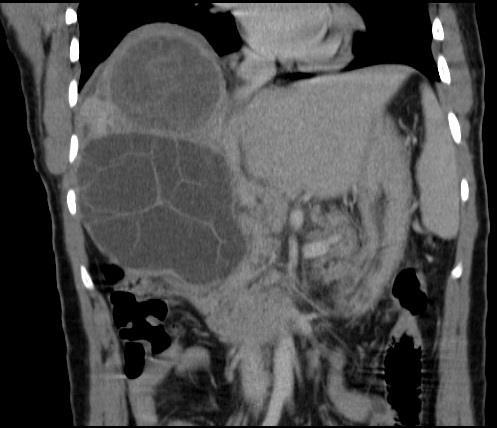 DIAGNOSTIC WORKUP Original pre-surgical 3 phase liver CT (coronal view) demonstrating a multilobulated 7.
