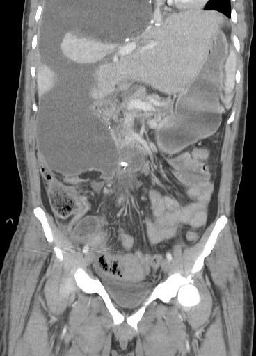 DIAGNOSTIC WORKUP One week after the right hepatectomy CT abdomen