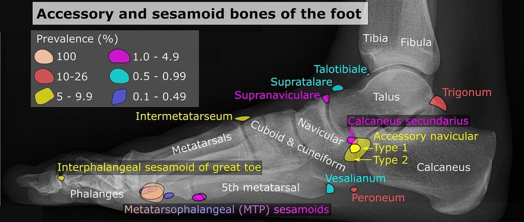 Calcification of sesamoid bone is one of the