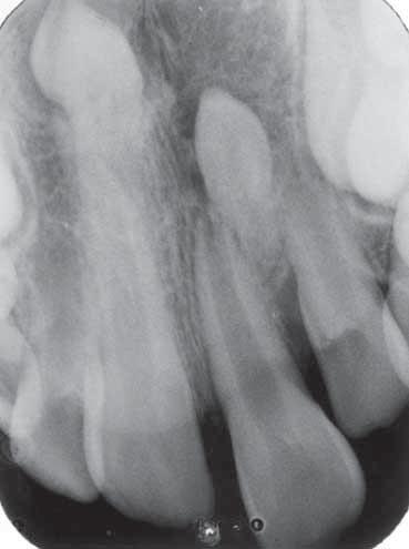 A second mesiodens was observed between the immature left central and lateral incisors.