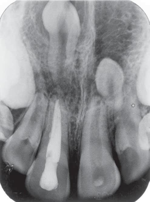 Six weeks later, extrusion was complete but vitality tests of the right central incisor were negative.