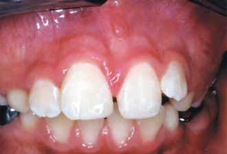 resorption (usually slow), ankylosis; 4) external inflammatory root resorption (very rapid possibly within 4 5 weeks).