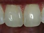 Commonly Suggested Dental Ceramics!