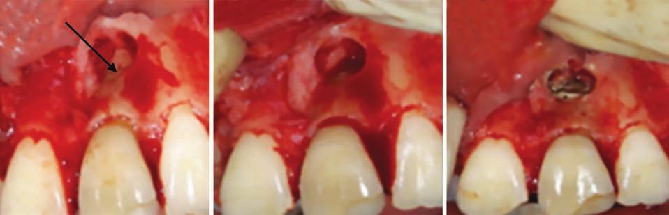 The root canal retreatment was initiated under rubber dam isolation in 21. The access cavity was redefined using Endo ccess ur and gutta-percha was retrieved. leeding from canal was present.