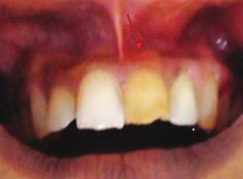 Patient had a history of trauma 4 years ago followed by a gradual change in color of tooth. Patient had undergone root canal treatment in a private dental clinic a week ago.