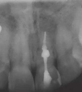 The granulation tissue was curetted from perforation site, and apical third of the canal was obturated with master cone of 60 size 2% gutta-percha.