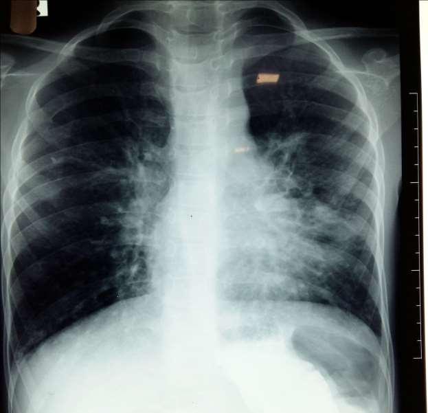 An examination of respiratory system revealed bilateral rhonchi with few coarse crepitations.