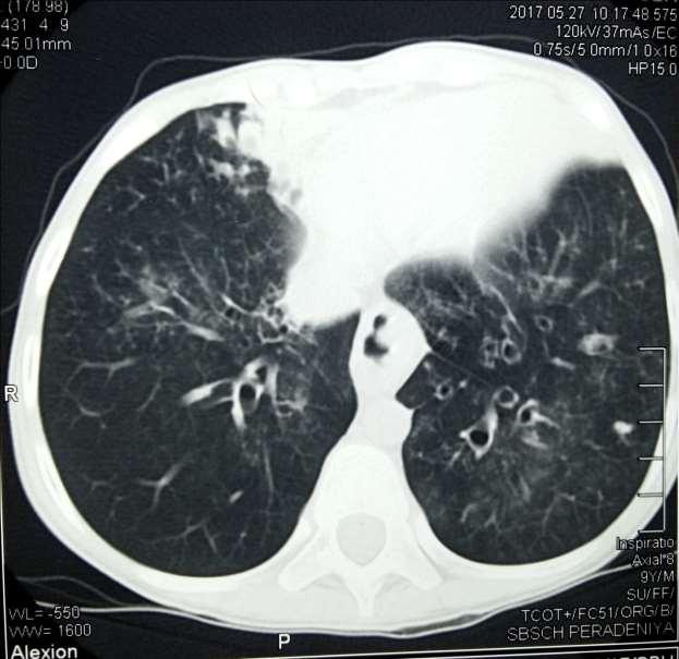 Figure 03 Her chest X-ray showed features of bronchiectasis involving the left lingular lobe.