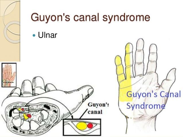 A Patient s Guide to Ulnar Nerve Entrapment at the Wrist (Guyon s Canal Syndrome) Introduction The ulnar nerve is often called the funny bone at the elbow.