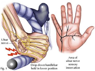 Repetitive trauma may be associated with the development of Guyon s canal syndrome Diagnosis Symptoms Patients report numbness, tingling or burning in the ulnar nerve distribution of the hand