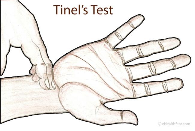 Tapping on the ulnar nerve at Guyon s canal reproduces symptoms of tingling in the small and ring finger.