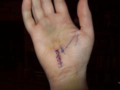 The patient may begin using the fingers and thumb after surgery for light activity and increase activity as tolerated.