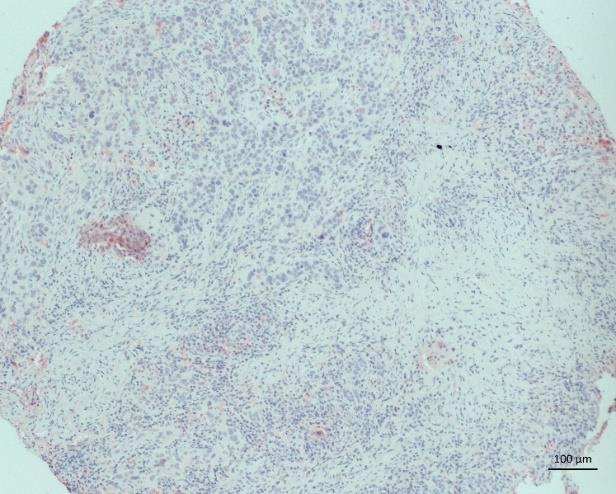 A B Figure 14: Representative ERα staining in human breast tumour and EO771 breast tumours in mice. Tumours were FFPE. Antigen retrieval was done using the pressure cooker method using citrate buffer.