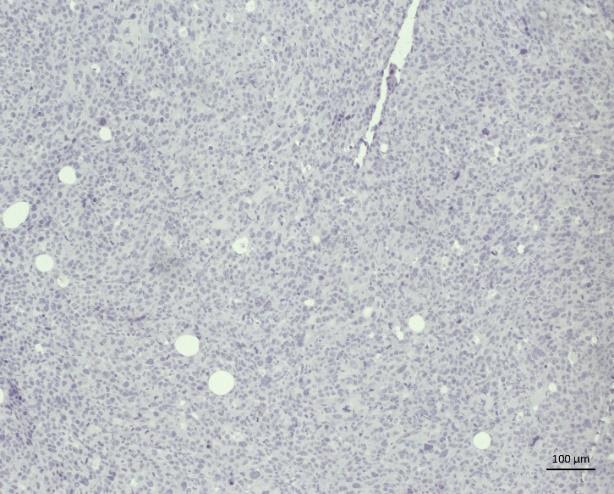 Intratumoral adipocytes, referred to as CAA, were examined by staining for perilipin.