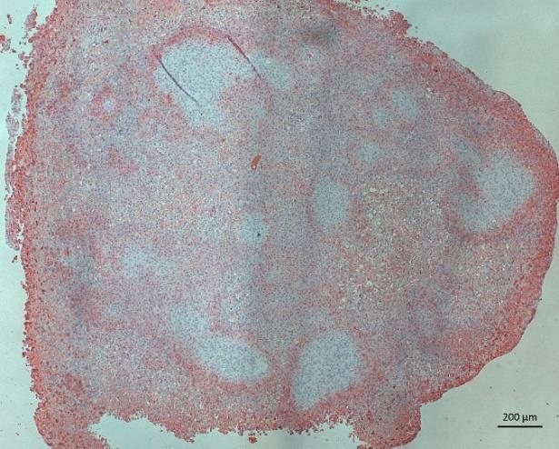 Figure 25: Representative hypoxia staining of pimonidazole in EO771 internal metastasis in ApoE mice Tumours were FFPE.