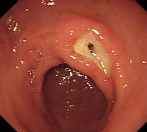 receive endoscopic therapy
