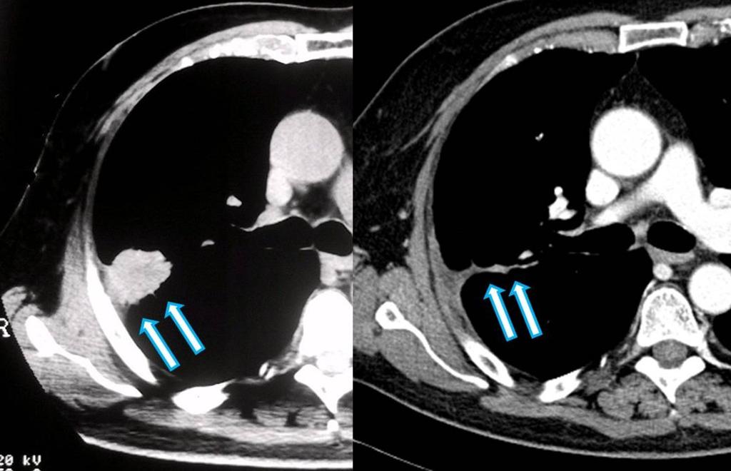 Fig. 4: CT images show a big CRC metastasis before of the