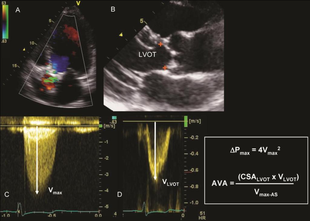 Confirmation of aortic stenosis severity Jet velocity >4.0 m/s Mean gradient >40-50 mmhg AVA <1.